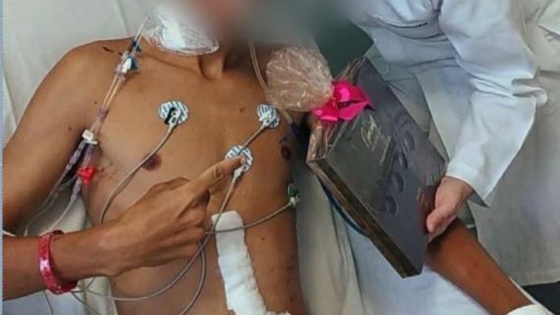 Jovem encontrado com intestino exposto em praia também teve traumas na face, diz laudo￼