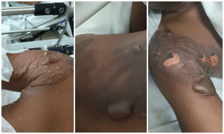 Mulher joga água quente no marido após descobrir mensagens com outra no Lobato
