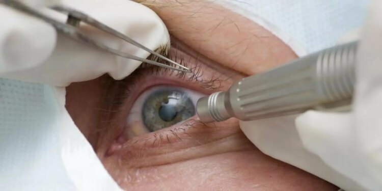 Procedimento cirúrgico de mudança de cor dos olhos é limitado a pacientes com cegueira