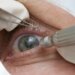 Procedimento cirúrgico de mudança de cor dos olhos é limitado a pacientes com cegueira
