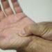 Fibromialgia é reconhecida como deficiência em todo o Brasil.
