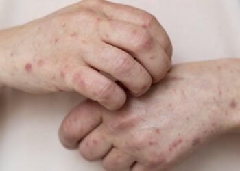 Novo caso suspeito de Mpox é investigado no interior da Bahia