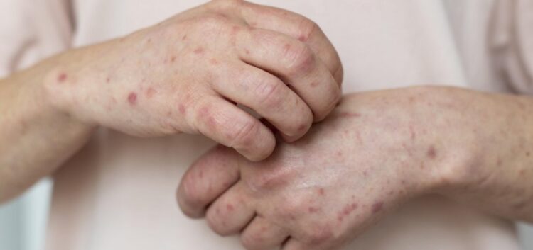 Novo caso suspeito de Mpox é investigado no interior da Bahia